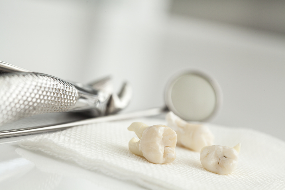 Should you have your wisdom teeth removed?